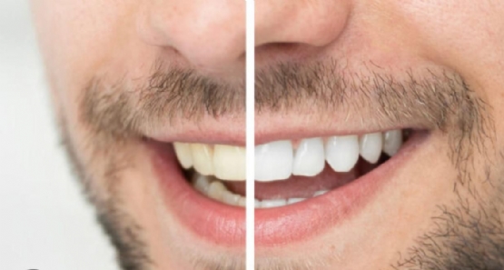 Zbardhim profesional i dhembeve,  pastrim gurzash, Klinike dentare durres, zbardhim profesional, noti, pastrim gurzash falas