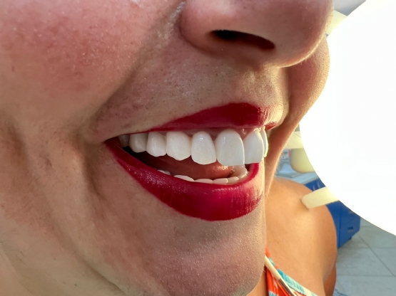 dhemb zirkoni, buzeqeshje ideale, trajtim i dhembeve, dentist ne durres, dentist ne plazh, klinika dentare durres , dhemb zirkoni, buzeqeshje ideale
